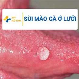 ai đã từng bị sùi mào gà