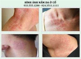 ảnh chụp màn hình cách chữa trị da gà ở cổ