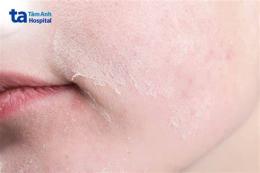 ảnh chụp màn hình cách trị da sần như da gà ở có