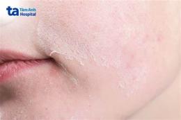 ảnh chụp màn hình da mặt bị sần như da gà