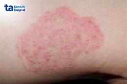 ảnh chụp màn hình gà bị nấm da