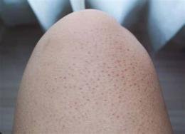 ảnh chụp màn hình keratosis pilaris da gà