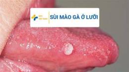 ảnh chụp màn hình nếu đã bị sùi mào gà mà chích hpv thì sao