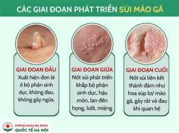 ảnh chụp màn hình sùi mào gà mọc trên da đầu