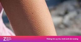 ảnh chụp màn hình tại sao khi trời lạnh lại nổi da gà