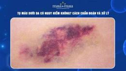 ảnh chụp màn hình tụ máu dưới da chân gà