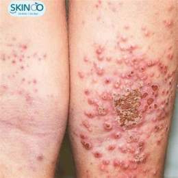 ảnh chụp màn hình viêm da cơ địa có ăn được trứng gà không