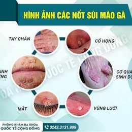 chữa sùi mào gà ở bệnh viện da liễu