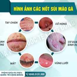 có ai đã chữa khỏi sùi mào gà?