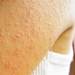 da có sần sùi như da gà