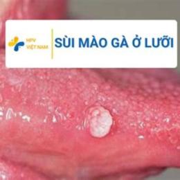 đã lưỡi có bị sùi mào gà không