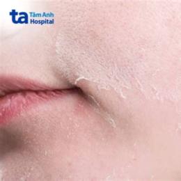 da mặt bị sần như da gà
