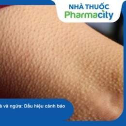 da nổi sần như da gà và ngứa