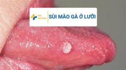 giao diện app đã lưỡi có bị sùi mào gà không