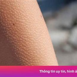 hay nổi da gà thường xuyên