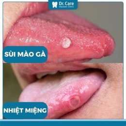 hướng dẫn sử dụng ai đã từng bị sùi mào gà