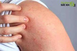 hướng dẫn sử dụng mông bị nổi hột như da gà