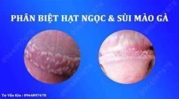 hướng dẫn sử dụng sùi mào gà giai đoạn đầu nam