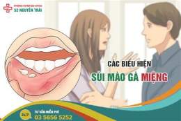hướng dẫn sử dụng sùi mào gà ở lưỡi giai đoạn đầu