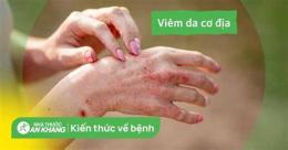 hướng dẫn sử dụng viêm da cơ địa có ăn được trứng gà không