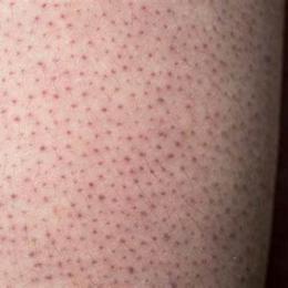 keratosis pilaris da gà