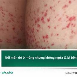mông bị nổi hột như da gà