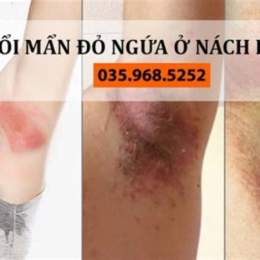 nách bị nổi da gà