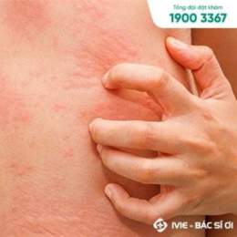 ngứa khắp người nổi da gà