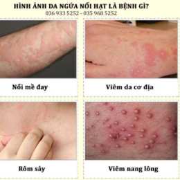 nổi da gà ngứa khắp người