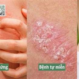 nổi mẩn da gà