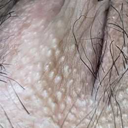 nổi mụn giống da gà