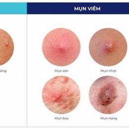 nổi mụn như da gà