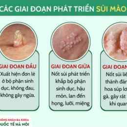 sùi mào gà mọc trên da đầu