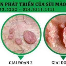 sùi mào gà ở da mặt