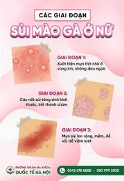 tính năng nổi bật chữa sùi mào gà ở bệnh viện da liễu