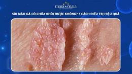 tính năng nổi bật có ai đã chữa khỏi sùi mào gà?