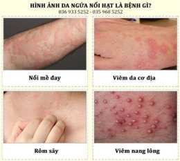 tính năng nổi bật da nổi từng mảng như da gà