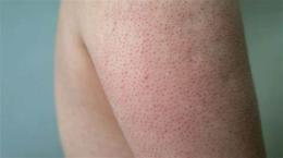 tính năng nổi bật keratosis pilaris da gà