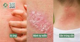 tính năng nổi bật nổi mẩn da gà