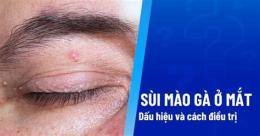 tính năng nổi bật sùi mào gà ở da mặt
