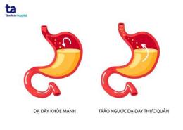 tính năng nổi bật trào ngược dạ dày có nên ăn thịt gà