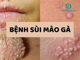 tính năng nổi bật tri benh sui mao ga o benh vien da lieu