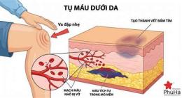 tính năng nổi bật tụ máu dưới da chân gà