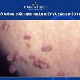 trị da gà ở mông