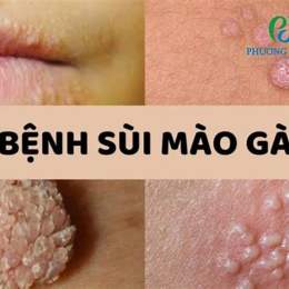 trị sùi mào gà bệnh viện da liễu