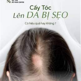 trứng chấy bám trên tóc gần da đầu